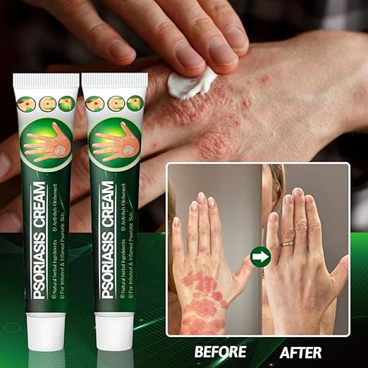 Psoriasis Cream - for Irritated & Inflamed Psoriatic Skin